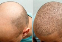hair transplant turkey